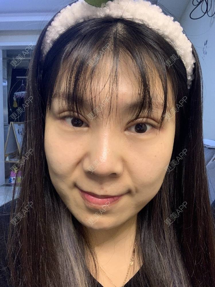 更美 - 更美我君的全切双眼皮经验 | 全切双眼皮