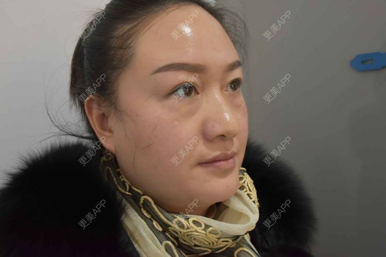 更美 - 更美用户Z28pYLcJqq的内切去眼袋经验 | 激光去眼袋 | 内切去眼袋 | 眶隔脂肪释放 | 北京