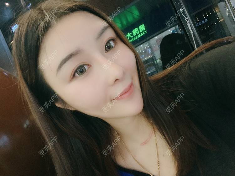 更美 - 呐呐😁的肋软骨隆鼻经验 | 北京 | 肋软骨隆鼻