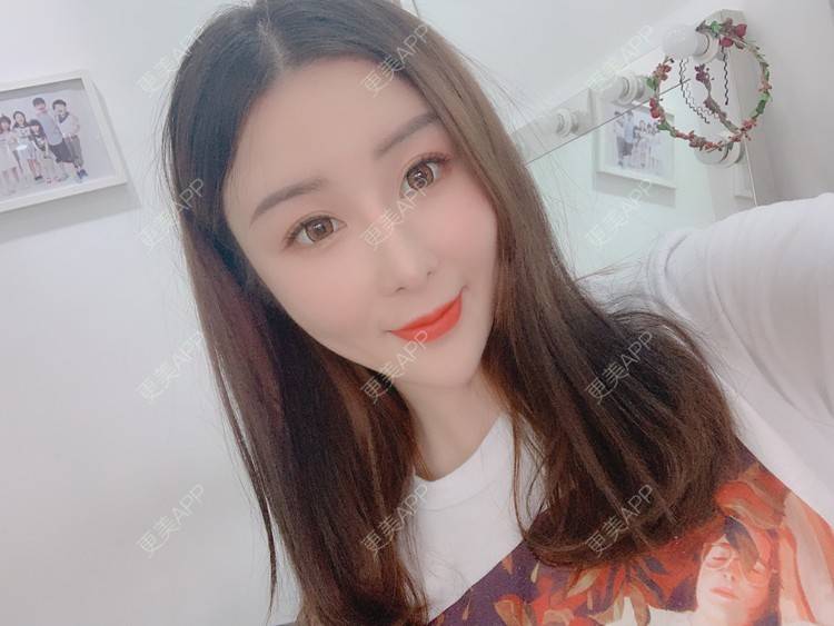更美 - 呐呐😁的肋软骨隆鼻经验 | 北京 | 肋软骨隆鼻