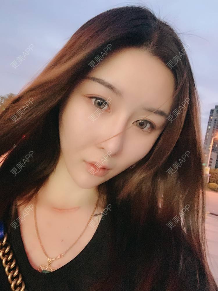 更美 - 呐呐😁的肋软骨隆鼻经验 | 北京 | 肋软骨隆鼻