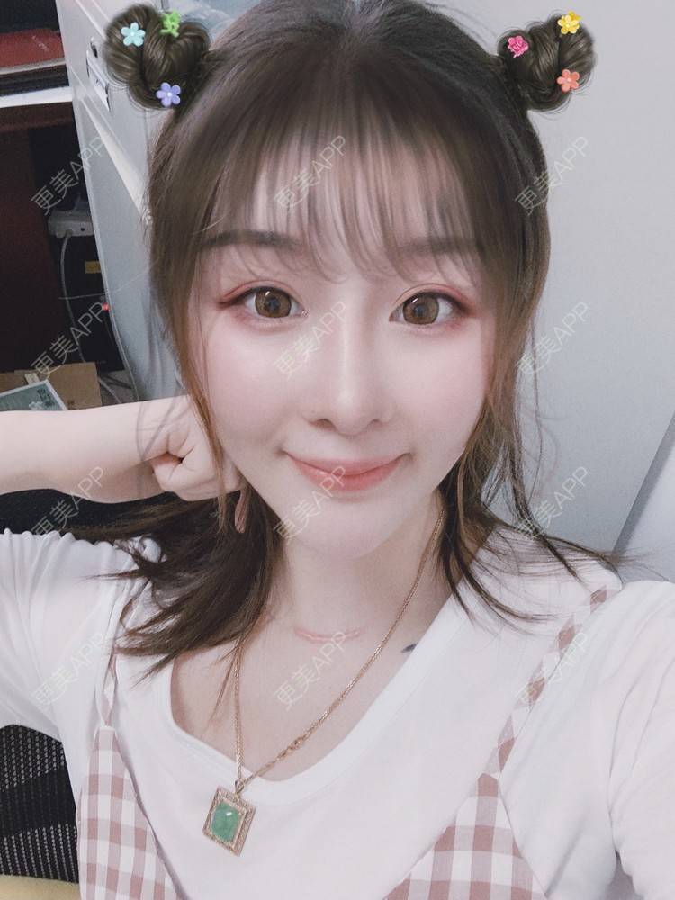 更美 - 呐呐😁的肋软骨隆鼻经验 | 北京 | 肋软骨隆鼻