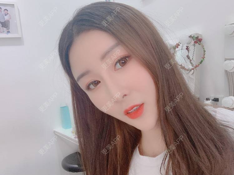 更美 - 呐呐😁的肋软骨隆鼻经验 | 北京 | 肋软骨隆鼻