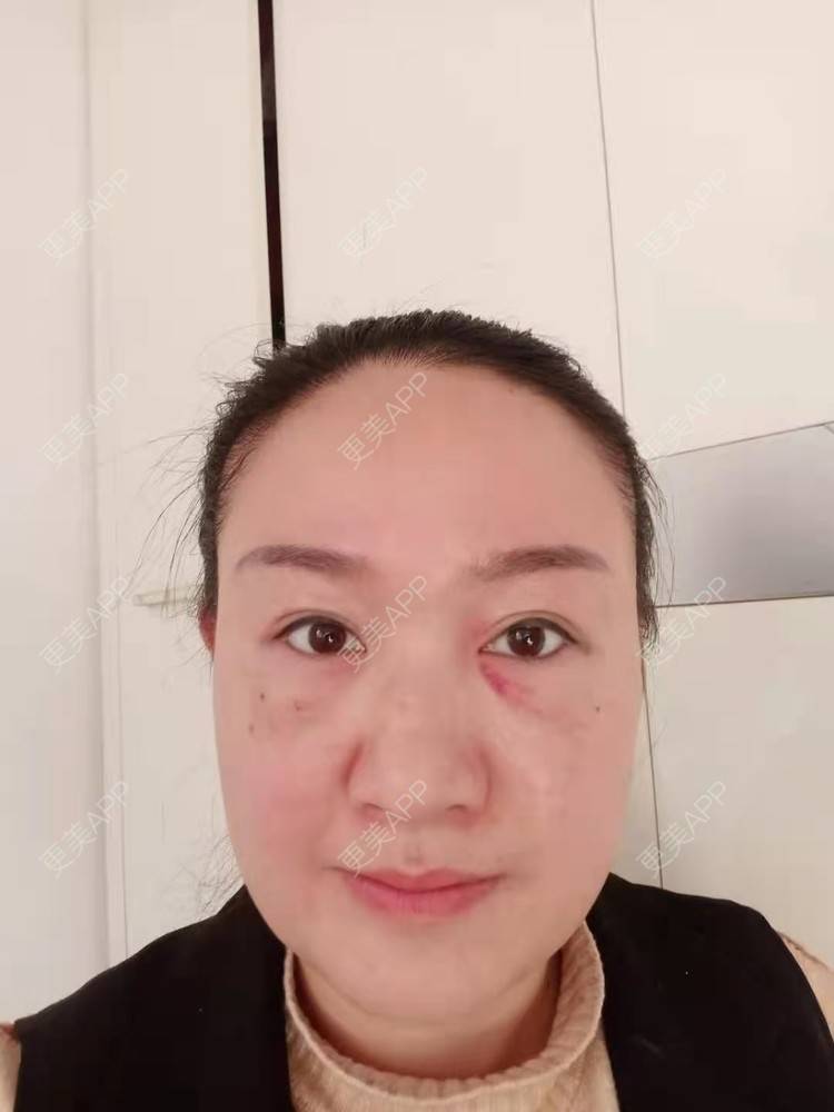 更美 - 更美用户Z28pYLcJqq的内切去眼袋经验 | 眶隔脂肪释放 | 内切去眼袋 | 激光去眼袋 | 北京