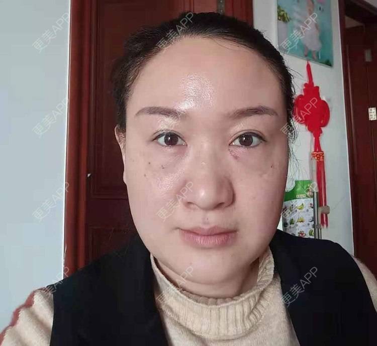 更美 - 更美用户Z28pYLcJqq的内切去眼袋经验 | 眶隔脂肪释放 | 内切去眼袋 | 激光去眼袋 | 北京