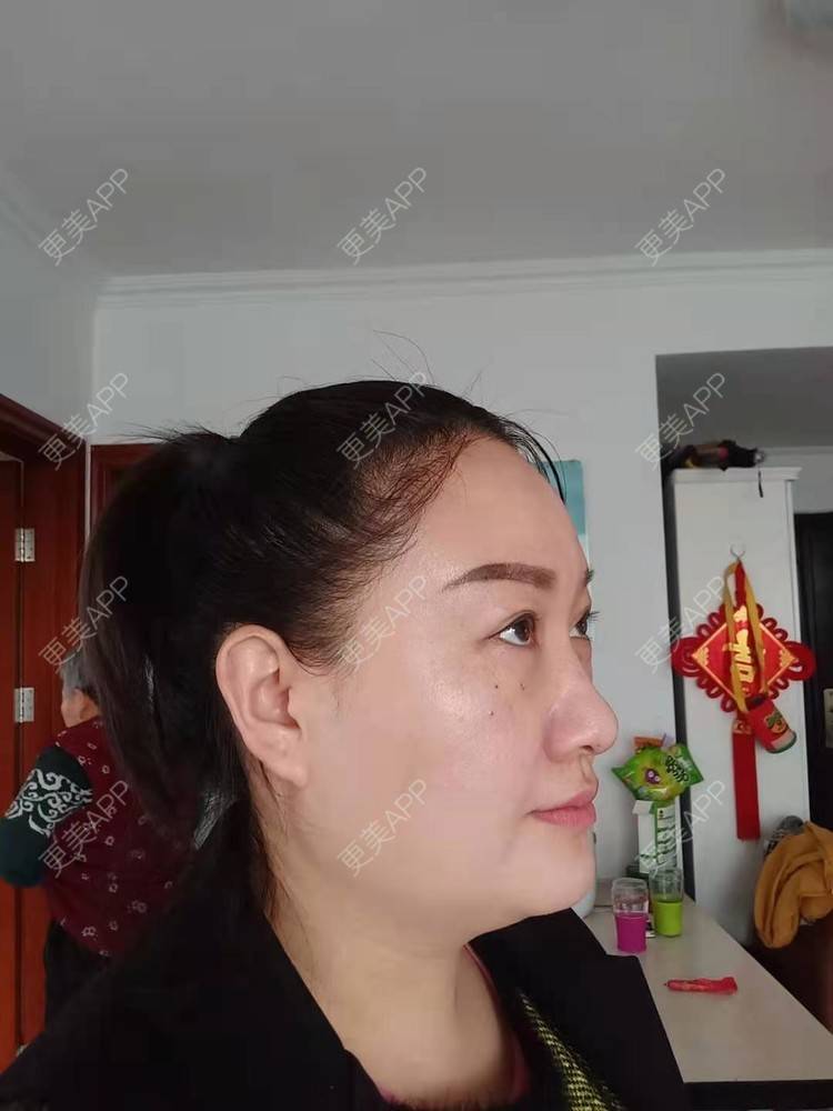 更美 - 更美用户Z28pYLcJqq的内切去眼袋经验 | 眶隔脂肪释放 | 内切去眼袋 | 激光去眼袋 | 北京
