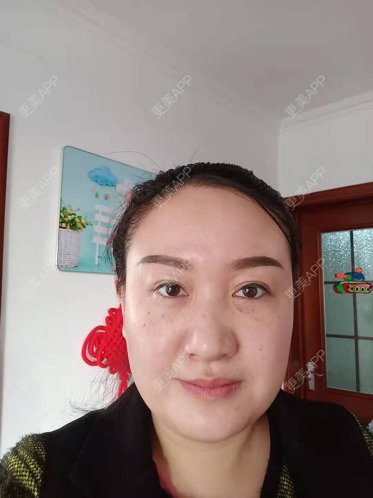 更美 - 更美用户Z28pYLcJqq的内切去眼袋经验 | 眶隔脂肪释放 | 内切去眼袋 | 激光去眼袋 | 北京