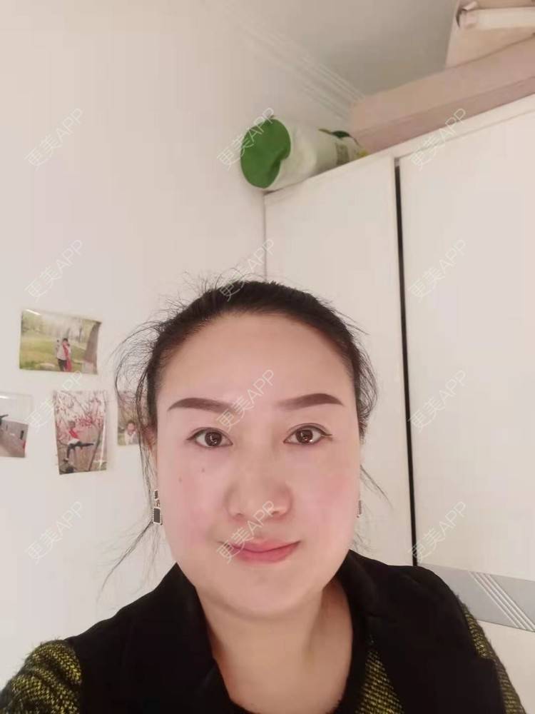 更美 - 更美用户Z28pYLcJqq的内切去眼袋经验 | 眶隔脂肪释放 | 内切去眼袋 | 激光去眼袋 | 北京