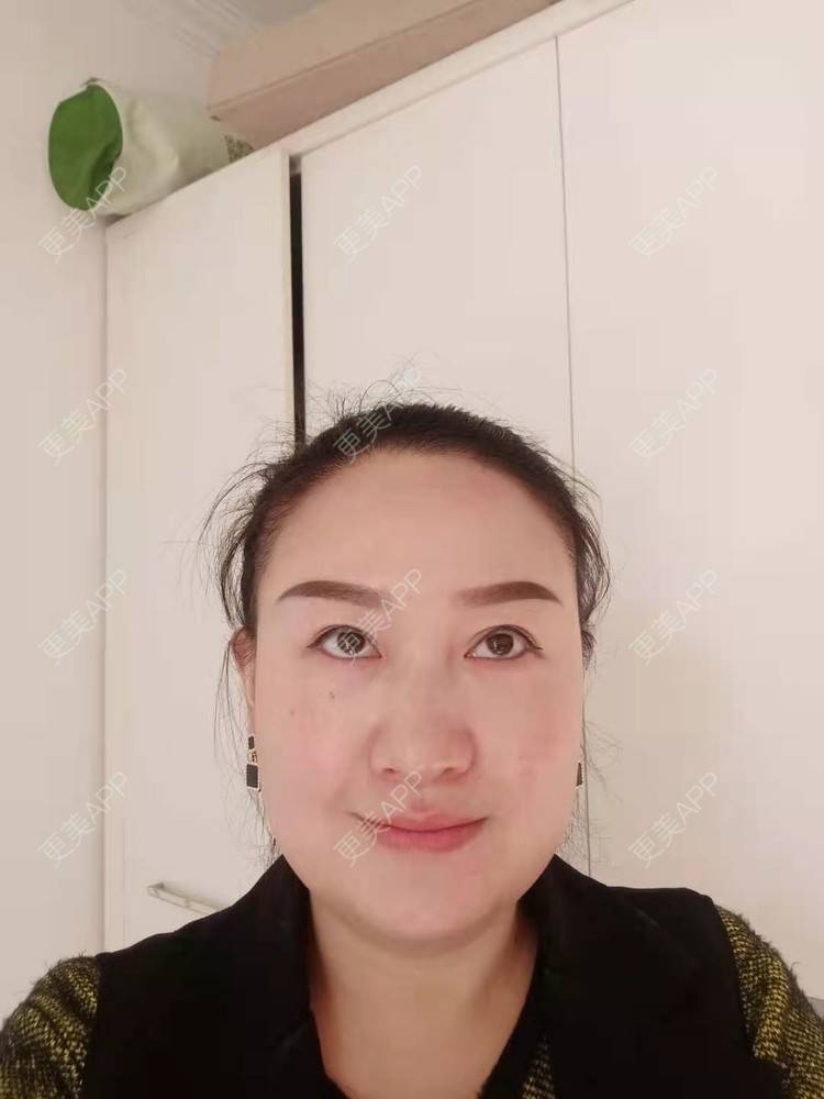 更美 - 更美用户Z28pYLcJqq的内切去眼袋经验 | 眶隔脂肪释放 | 内切去眼袋 | 激光去眼袋 | 北京