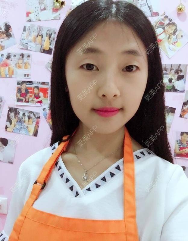 更美 - 更美用户DVJNfKigag的光子嫩肤经验 | 光子嫩肤