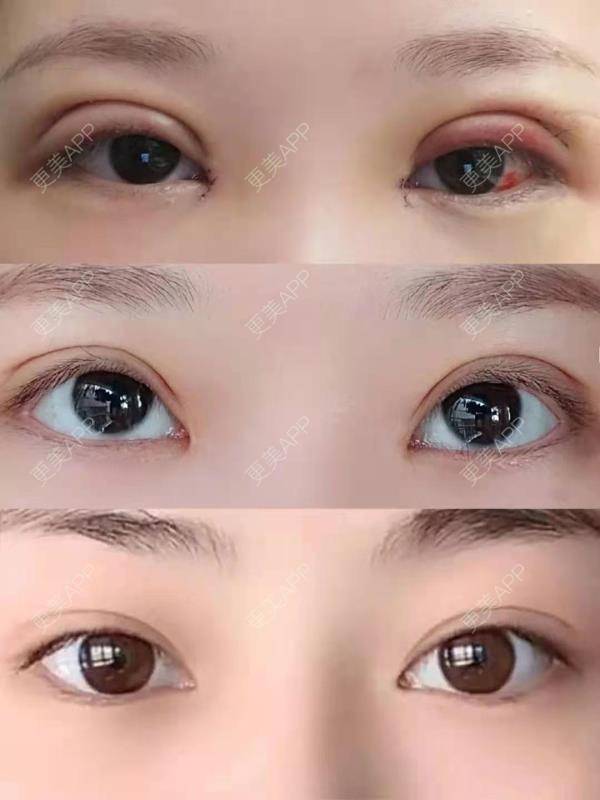 更美 - 可可丫！的双眼皮经验 | 双眼皮 | 双眼皮修复