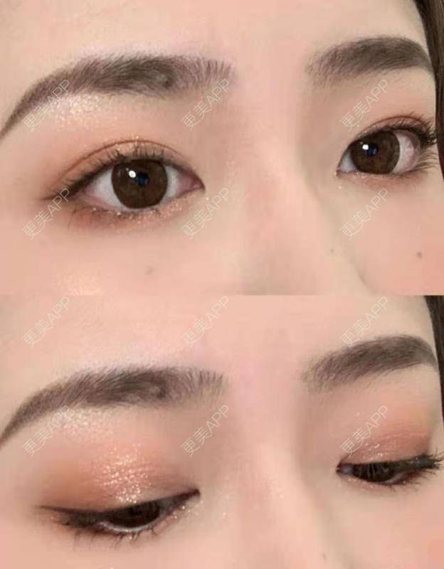 更美 - 可可丫！的双眼皮经验 | 双眼皮 | 双眼皮修复