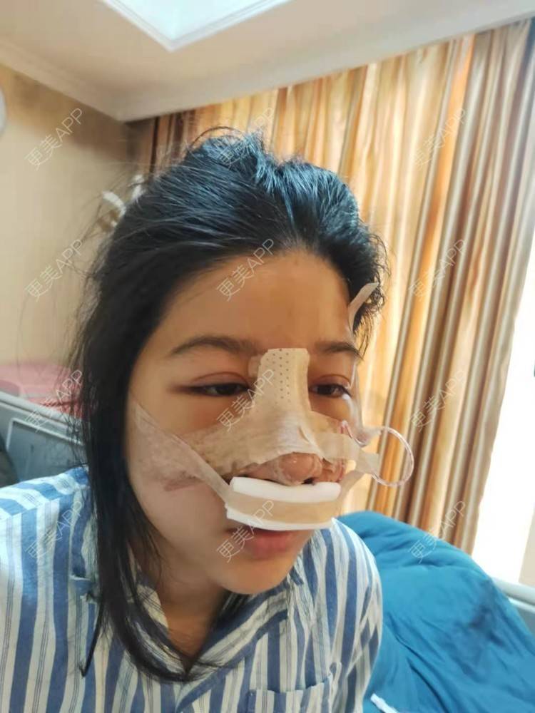 更美 - 更美用户yt3y7WvMpc的隆鼻经验 | 隆鼻 | 广州