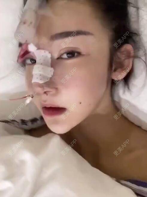 更美 - 分分秒秒拼的鼻部多项经验 | 鼻部多项 | 厦门