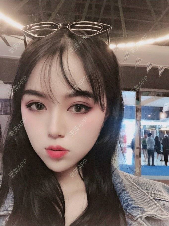 更美 - 更美用户36jxnTN8Yj的厚唇改薄经验 | 厚唇改薄 | 上海