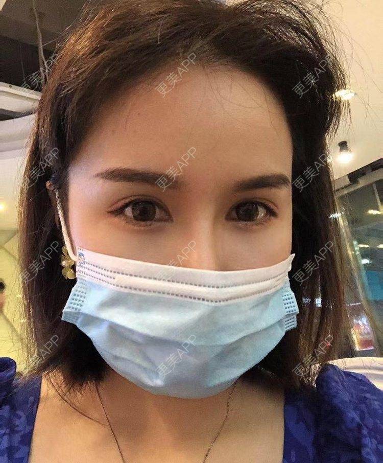 更美 - 妍👀小的膨体隆鼻经验 | 膨体隆鼻 | 肋软骨隆鼻 | 鼻翼缩小