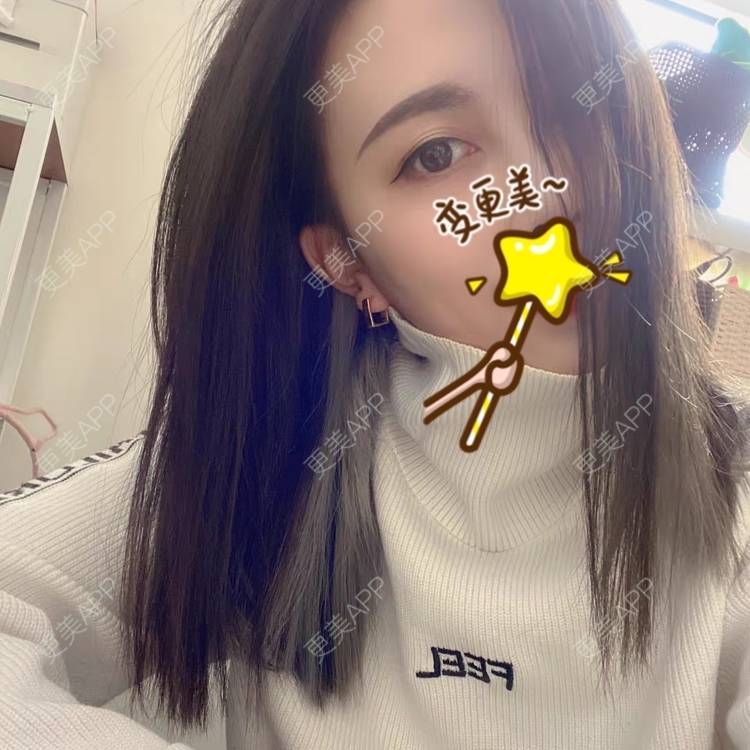 更美 - 更美用户FIQww4cKMN的射频提升经验 | 西安 | 射频提升