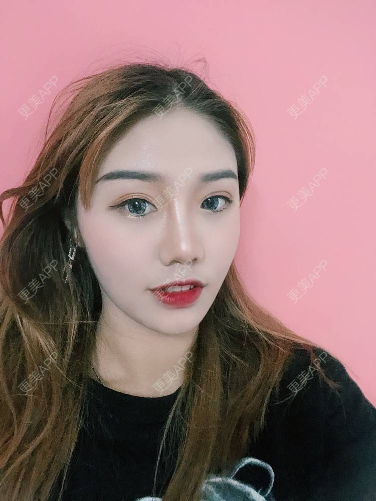 更美 - 更美用户DmEbgEZQGf的硅胶隆鼻经验 | 硅胶隆鼻 | 广州 | 视频日记