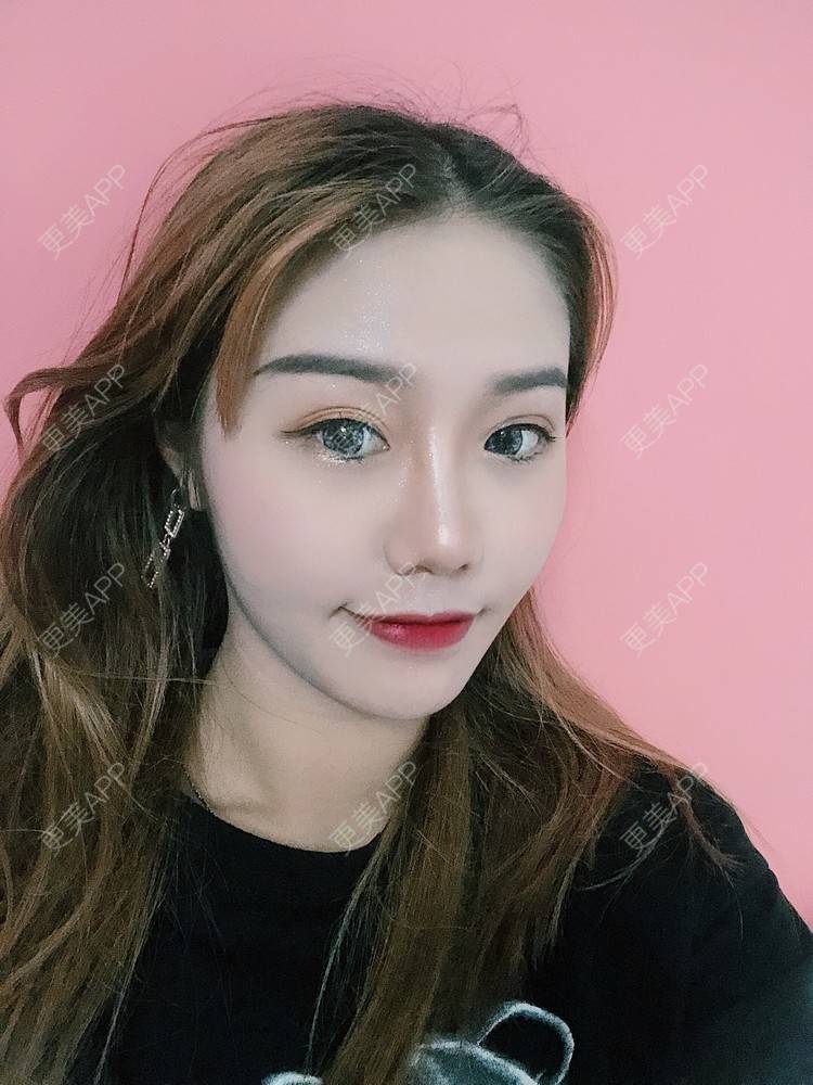 更美 - 更美用户DmEbgEZQGf的硅胶隆鼻经验 | 硅胶隆鼻 | 广州 | 视频日记