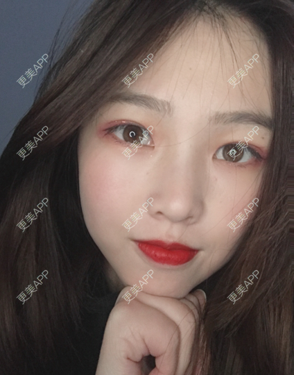 更美 - 更美用户mpyvE48XXs的眼部多项经验 | 郑州 | 眼部多项