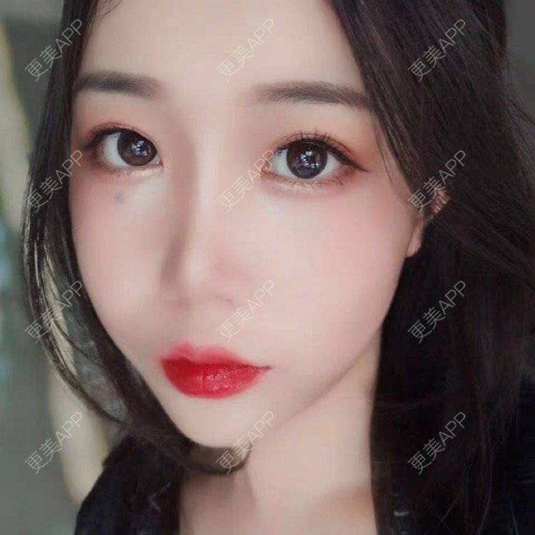更美 - 更美用户36jxnTN8Yj的自体脂肪丰苹果肌经验 | 自体脂肪丰苹果肌 | 上海