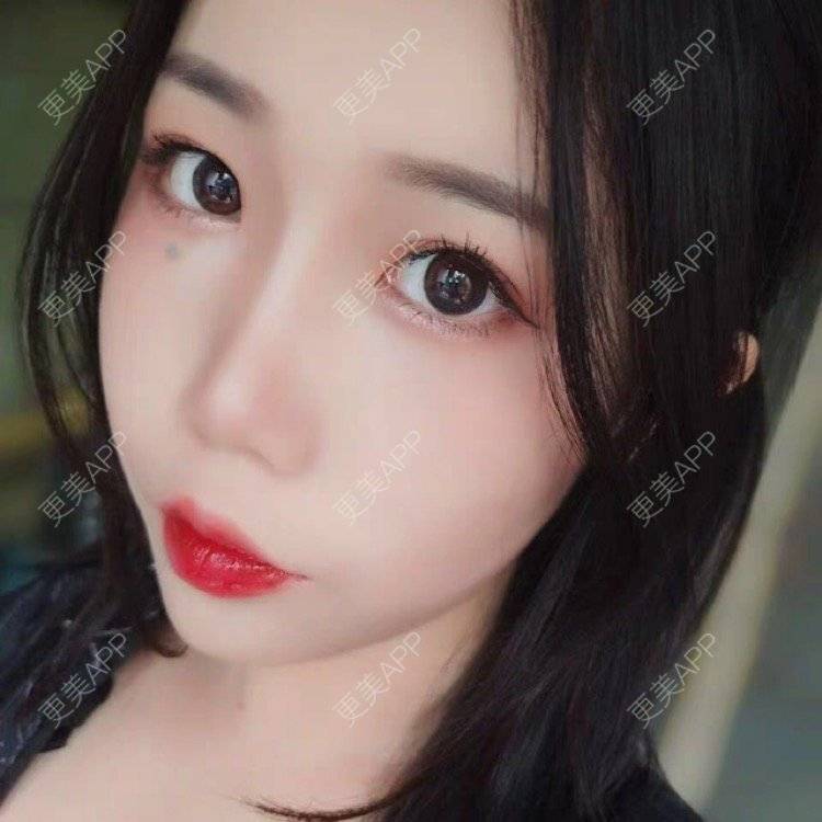 更美 - 更美用户36jxnTN8Yj的自体脂肪丰苹果肌经验 | 自体脂肪丰苹果肌 | 上海