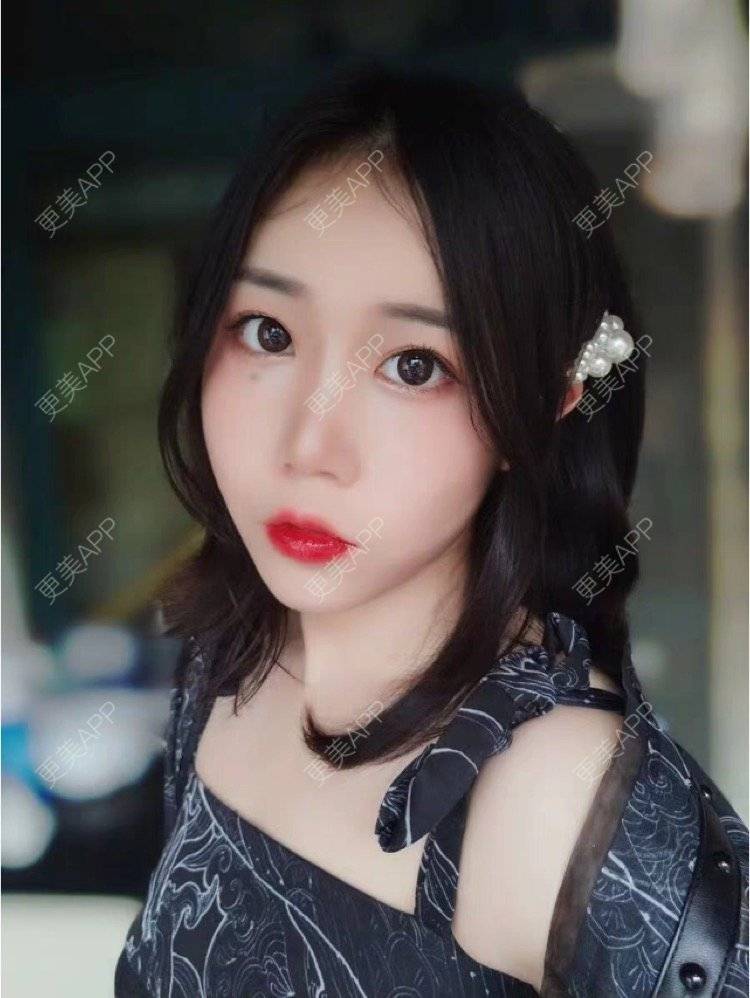 更美 - 更美用户36jxnTN8Yj的自体脂肪丰苹果肌经验 | 自体脂肪丰苹果肌 | 上海