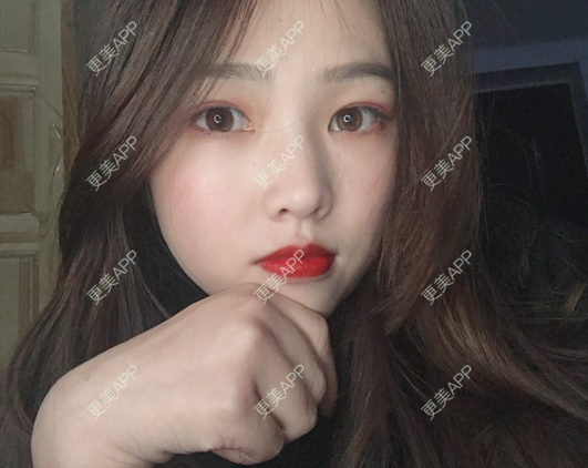 更美 - 更美用户mpyvE48XXs的眼部多项经验 | 郑州 | 眼部多项