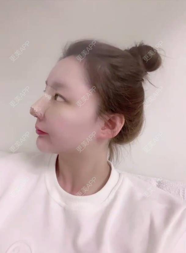 更美 - 金金伯利的鼻部多项经验 | 鼻部多项 | 厦门