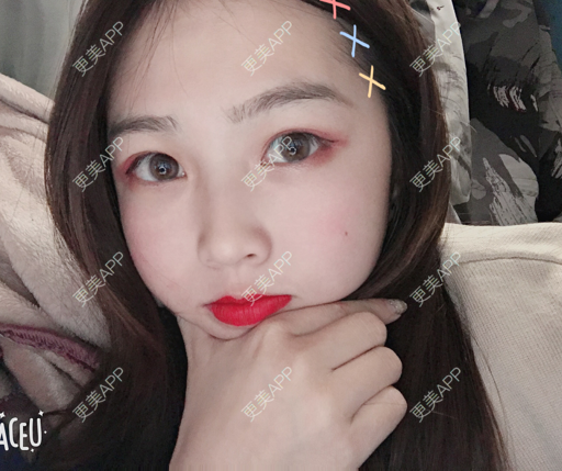 更美 - 更美用户mpyvE48XXs的眼部多项经验 | 郑州 | 眼部多项