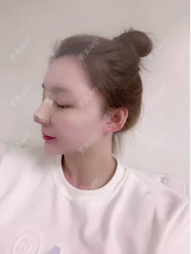 更美 - 金金伯利的鼻部多项经验 | 鼻部多项 | 厦门