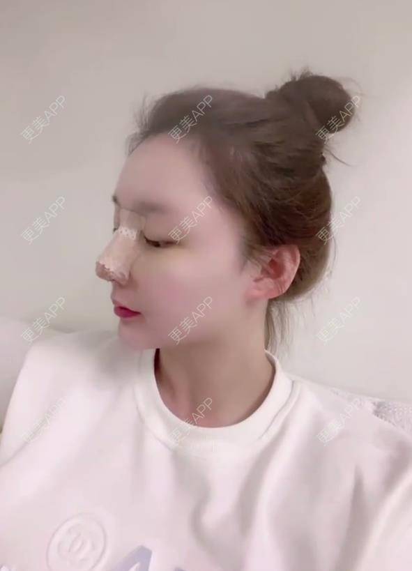 更美 - 金金伯利的鼻部多项经验 | 鼻部多项 | 厦门
