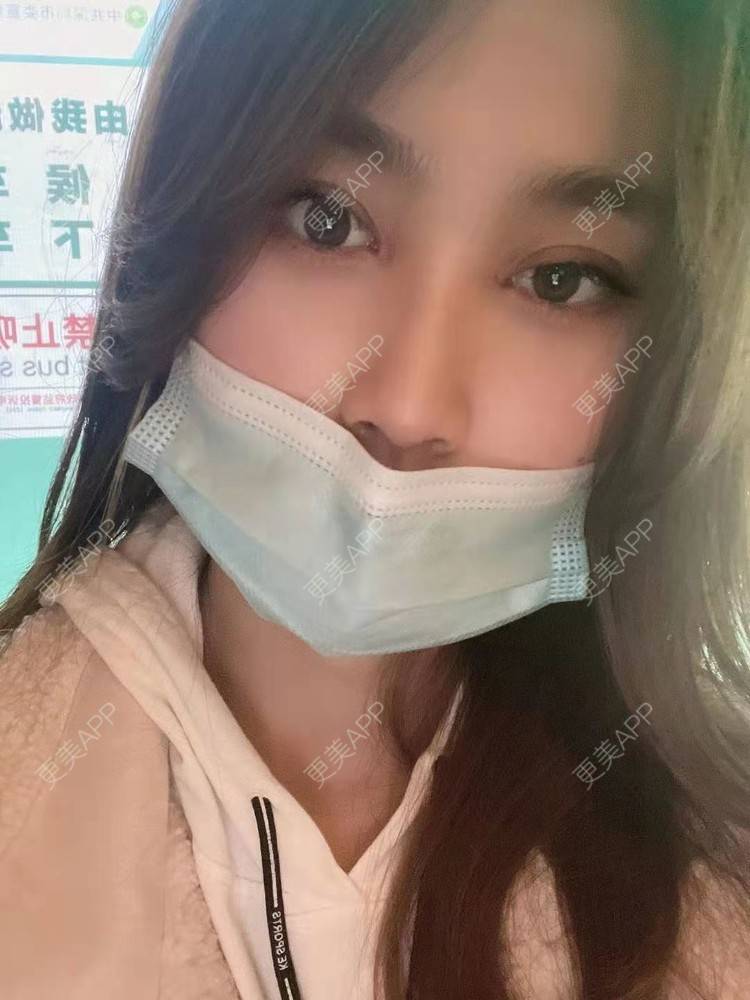 更美 - 更美用户LK67zZ3Pio的定点双眼皮经验 | 深圳 | 定点双眼皮