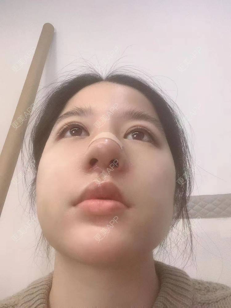 更美 - 更美用户yt3y7WvMpc的隆鼻经验 | 隆鼻 | 广州