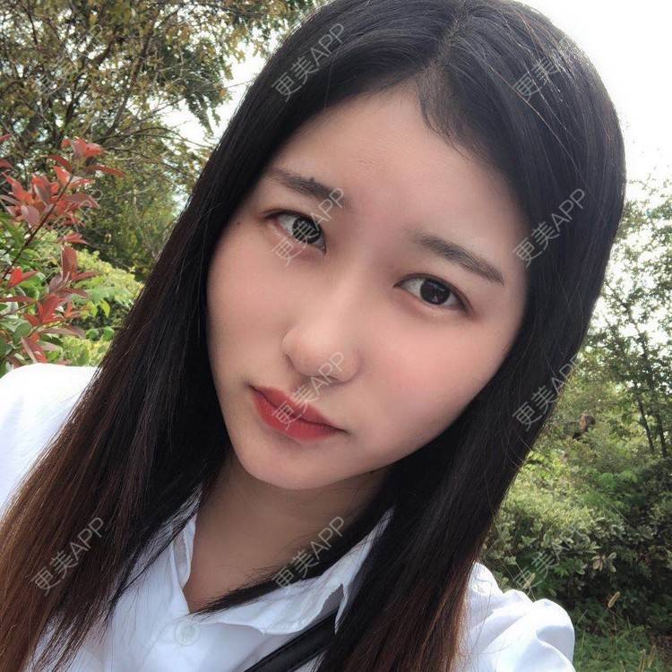 更美 - 更美用户jm8vH9SZww的全切双眼皮经验 | 全切双眼皮