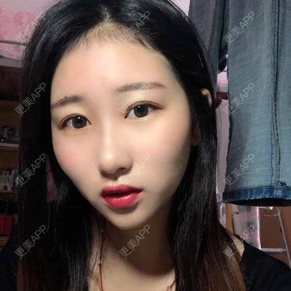更美 - 更美用户jm8vH9SZww的全切双眼皮经验 | 全切双眼皮