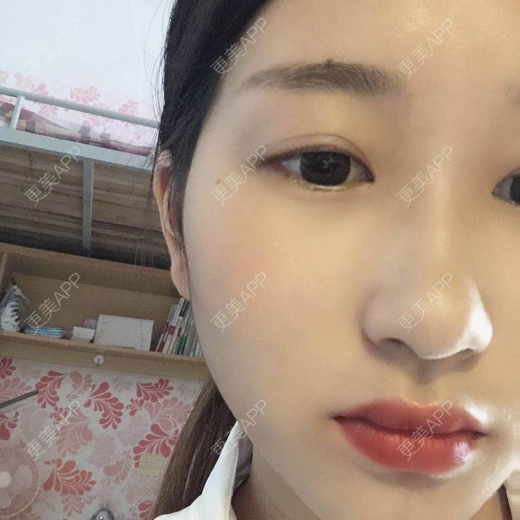 更美 - 更美用户jm8vH9SZww的全切双眼皮经验 | 全切双眼皮