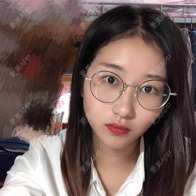 更美 - 更美用户jm8vH9SZww的全切双眼皮经验 | 全切双眼皮