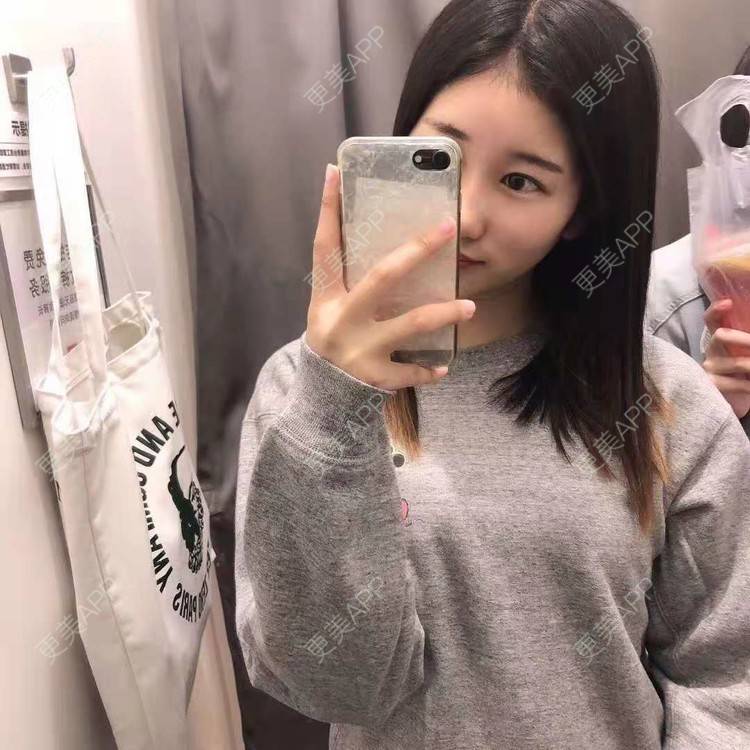 更美 - 更美用户jm8vH9SZww的全切双眼皮经验 | 全切双眼皮