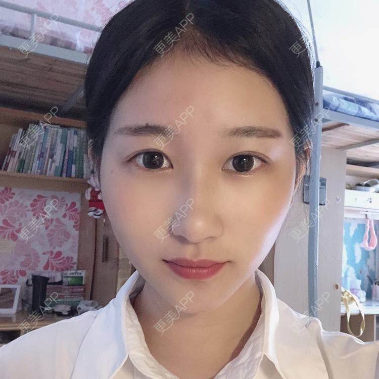 更美 - 更美用户jm8vH9SZww的全切双眼皮经验 | 全切双眼皮