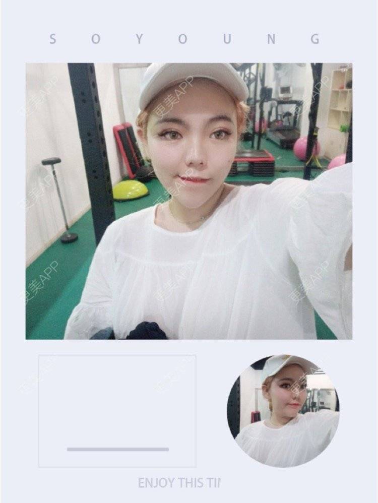 更美 - 更美用户Igf0wueJ8d的果酸焕肤经验 | 上海 | 果酸焕肤