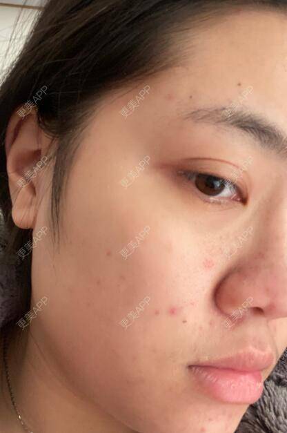 更美 - 更美用户21XDd9XGQN的红蓝光清痘经验 | 红蓝光清痘 | 深圳