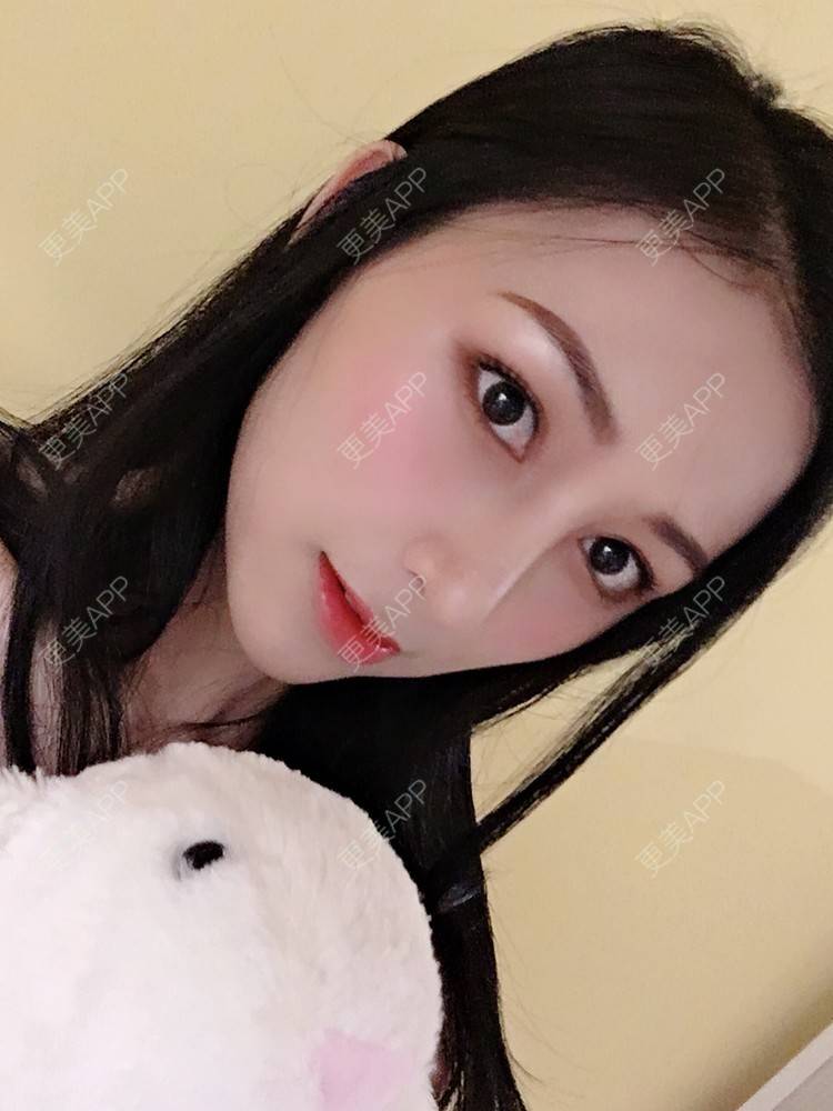更美 - 悠悠苍天有眼的肋软骨隆鼻经验 | 广州 | 肋软骨隆鼻 | 视频日记