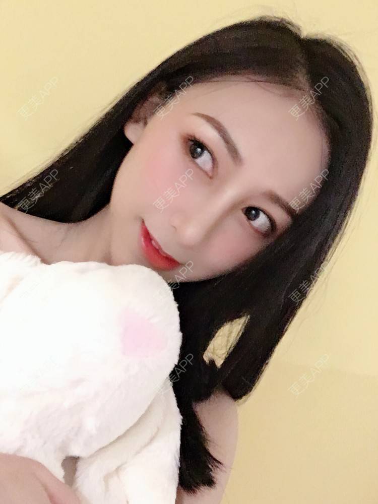 更美 - 悠悠苍天有眼的肋软骨隆鼻经验 | 广州 | 肋软骨隆鼻 | 视频日记