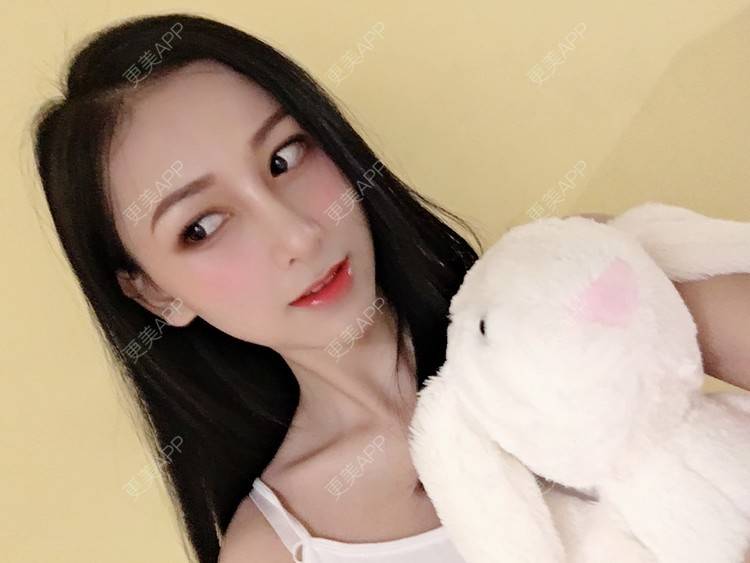 更美 - 悠悠苍天有眼的肋软骨隆鼻经验 | 广州 | 肋软骨隆鼻 | 视频日记