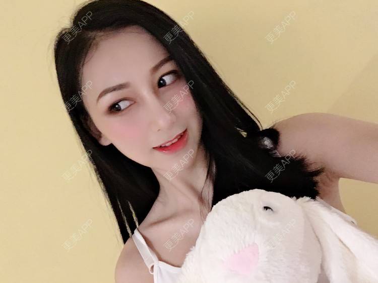 更美 - 悠悠苍天有眼的肋软骨隆鼻经验 | 广州 | 肋软骨隆鼻 | 视频日记