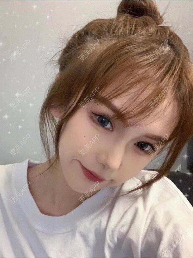 更美 - 更美用户Igf0wueJ8d的点阵激光经验 | 上海 | 点阵激光