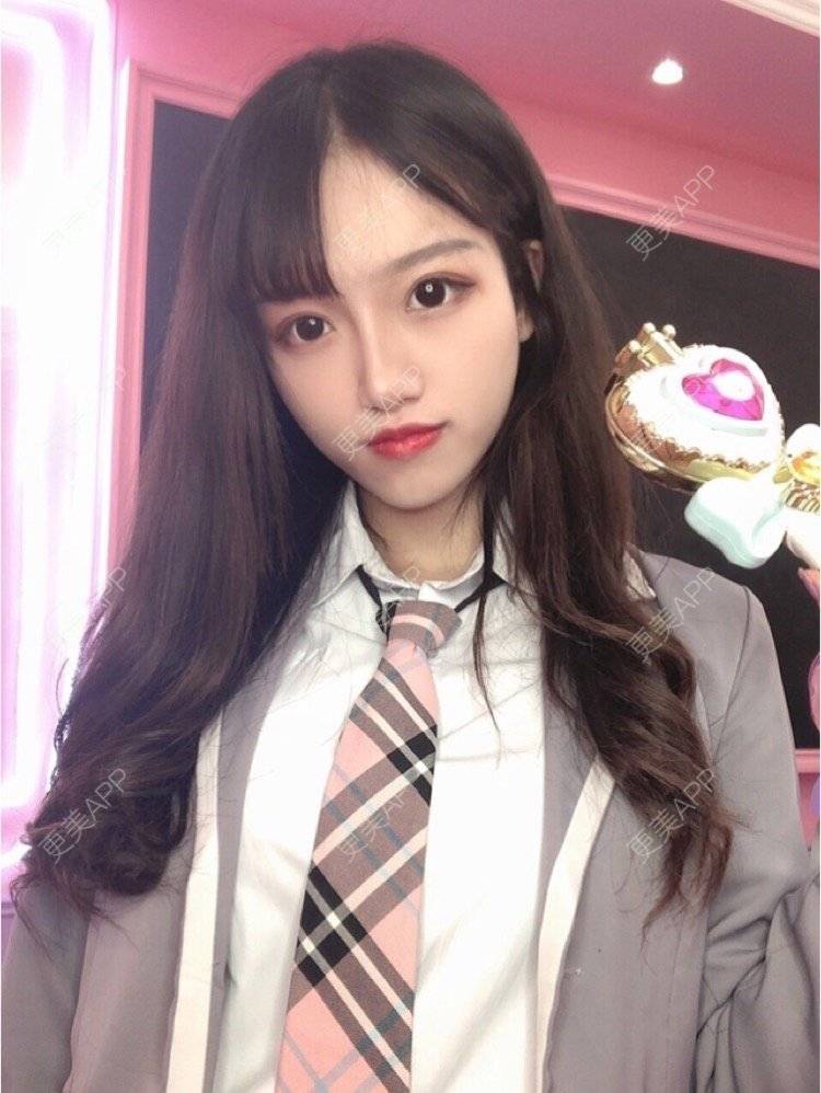 更美 - 更美用户Igf0wueJ8d的厚唇改薄经验 | 厚唇改薄 | 上海