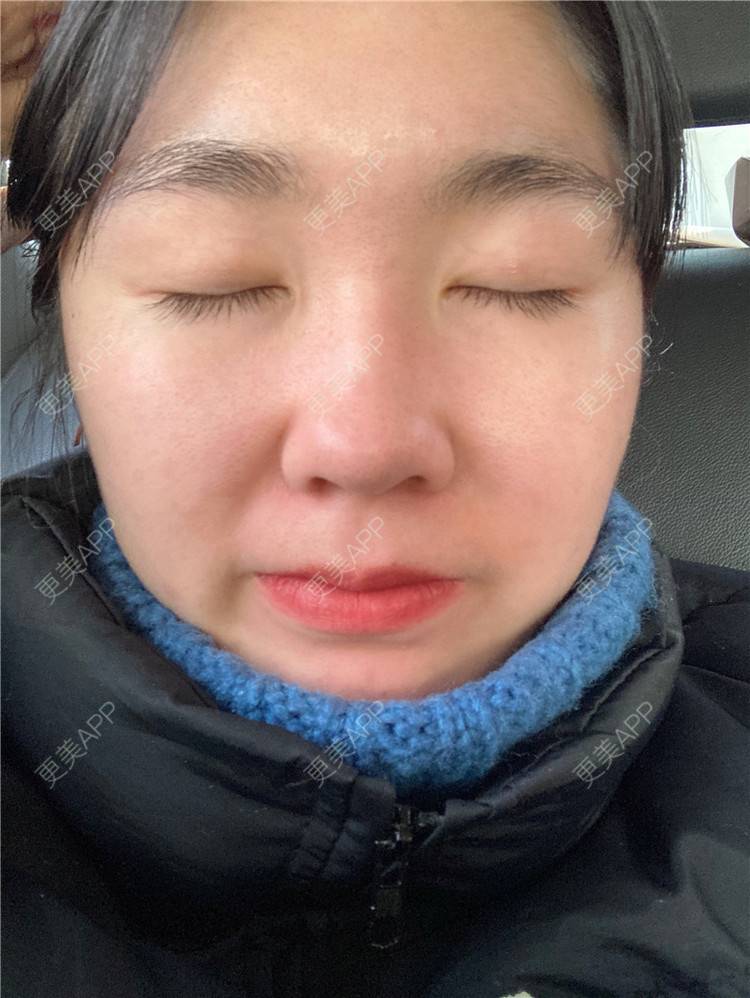 更美 - 更美用户pfRDlXmvTW的定点双眼皮经验 | 定点双眼皮 | 长沙