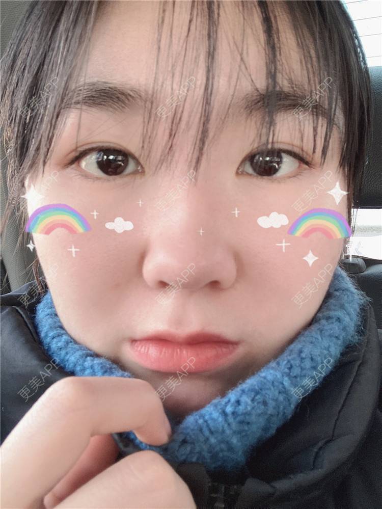 更美 - 更美用户pfRDlXmvTW的定点双眼皮经验 | 定点双眼皮 | 长沙